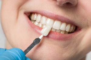 Scoprite come i nostri professionisti creano faccette con una precisa corrispondenza di colore che si fondono perfettamente con il colore naturale dei vostri denti. 