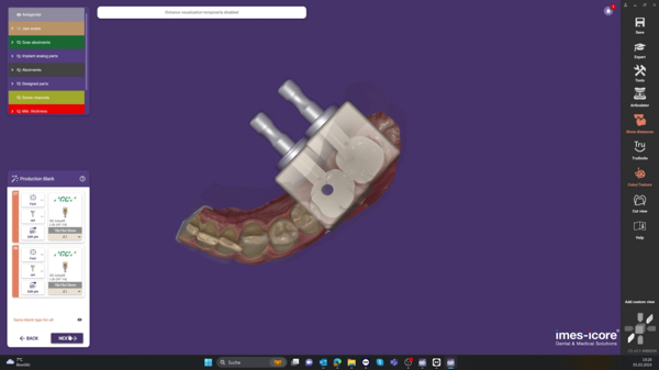 Exact design of the dental restoration is planned in CAD software, in this case Exocad Chairside