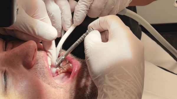 The final denture is inserted in the patient