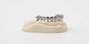 Image of a dental prosthesis model using telescopic technique (right).