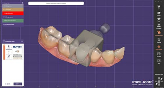 3D-Modell einer Zahnprothese auf Unterkiefer in CAD/CAM-Software