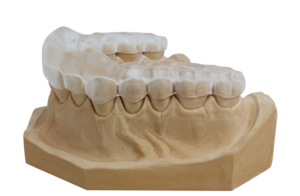 Occlusal splint on a dental model, showing therapeutic applications in dentistry