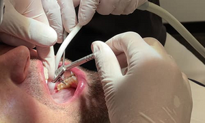 Fertigstellung Restauration in der Zahnarztpraxis und Labor