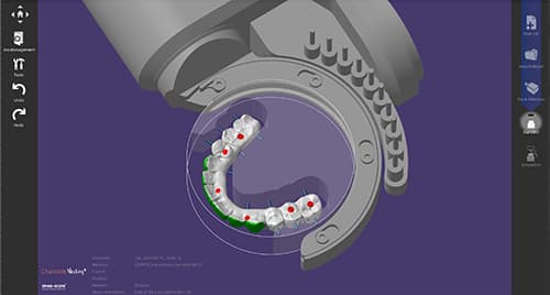 Ansicht eines Zahnmodells mit markierten Kontaktstellen in einer Dentalsoftware.