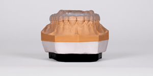 Okklusionsschiene auf Zahnmodell, demonstriert Anpassung für individuelle Patientenbedürfnisse