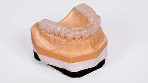 A modern occlusal splint made of clear plastic, fitted on a plaster dental model, demonstrating advanced materials and manufacturing techniques