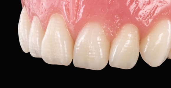 Nahaufnahme der Frontzähne einer Zahnprothese